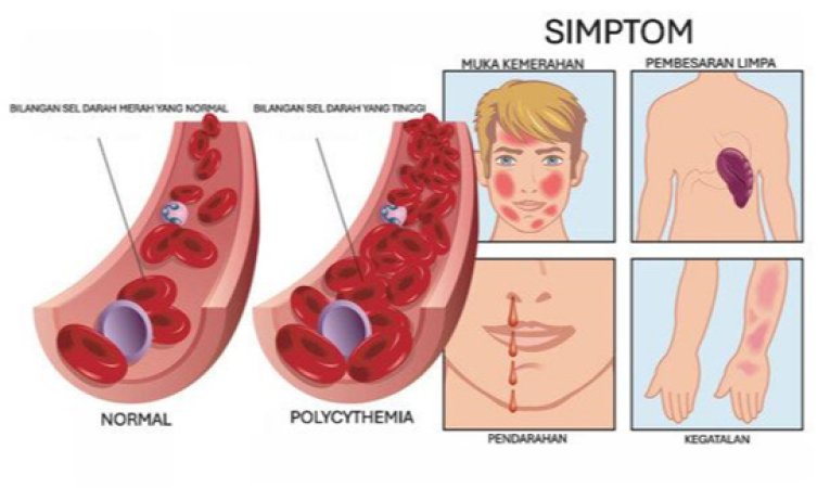 Polycythemia: Penyakit Darah Pekat Yang Kurang Dikenali