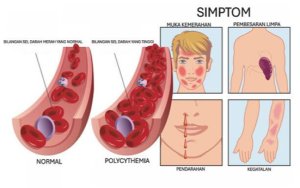 Polycythemia: Penyakit Darah Pekat Yang Kurang Dikenali