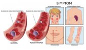 Polycythemia: Penyakit Darah Pekat Yang Kurang Dikenali