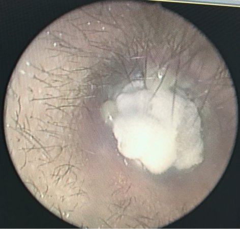 Part 1: Ear Wax, A Natural Defense Mechanism.