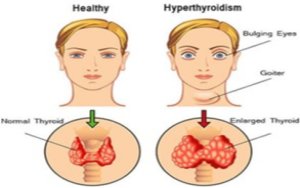 Hyperthyroidism in Nuclear Medicine