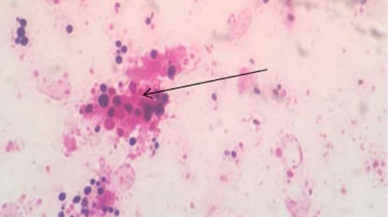 Jangkitan Candida Albicans
