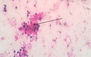 Jangkitan Candida Albicans