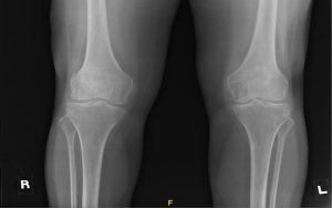 Sakit Lutut - Adakah Anda Mengalami Radang Sendi (Osteoarthritis)?